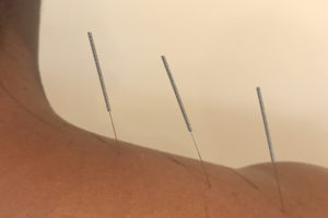 Acupuncture Close-Up
