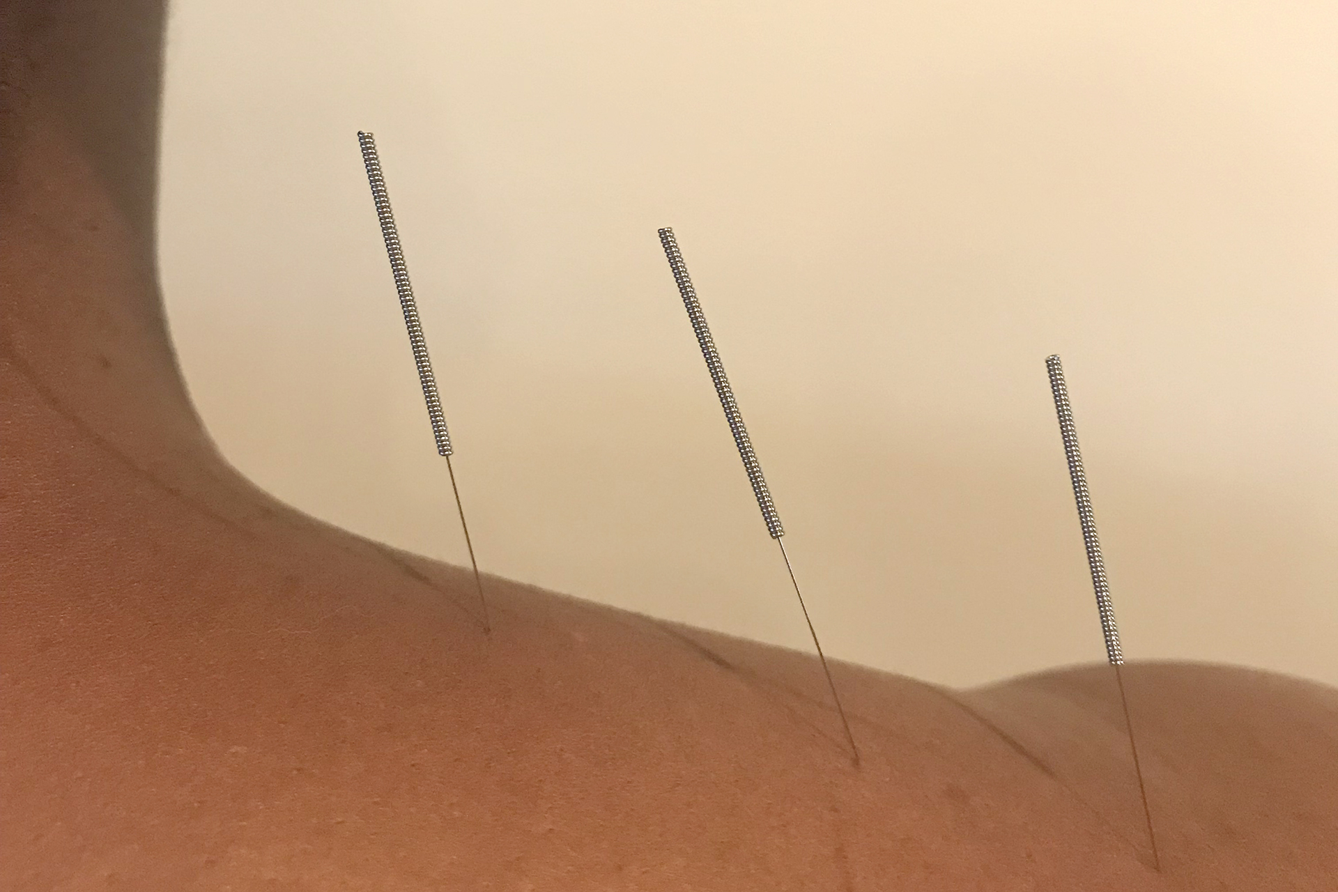 tina 4 Home Columbus | Westerville Acupuncture