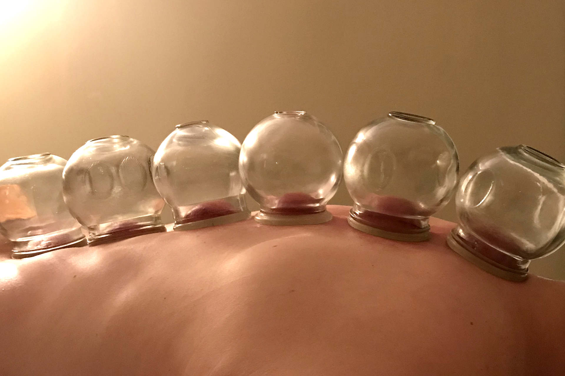 Services &#8211; Cupping Therapy