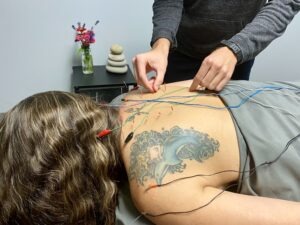 Services &#8211; Private Acupuncture